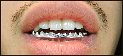 KOHH' new GRILLZ!!!!!!!（KOHH様ニューグリルズ） | GRILLZ JEWELZ BLOG