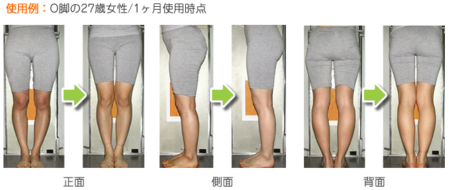 O脚・X脚矯正 | 広島市南区で口コミ上位 あさひ整骨院