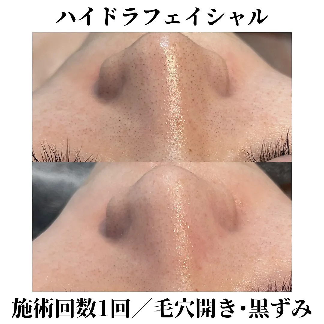 ハイドラ毛穴洗浄 | ギャラリー | 北九州でエステならTOTAL BEAUTY