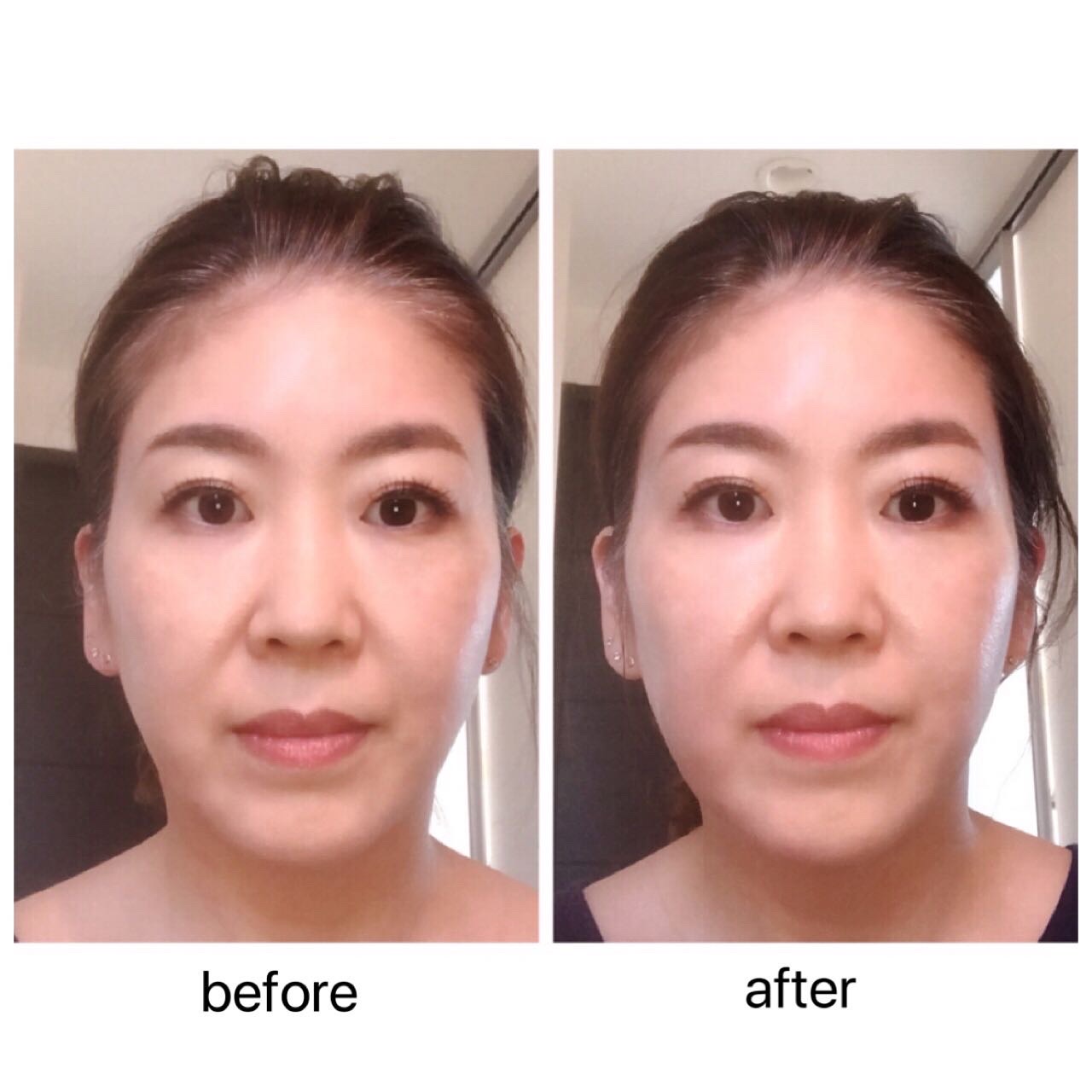 NEWAリフト 直前直後の比較 | 福岡市城南区の美容皮膚科｜タケダ