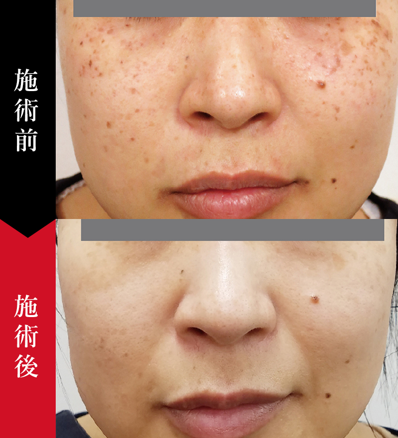 しみ・肝斑・そばかすの症例｜椿クリニック 銀座・名古屋・心斎橋