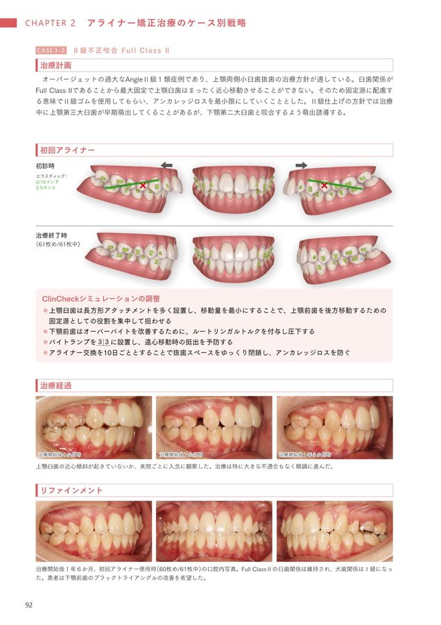 アライナー矯正治療戦略