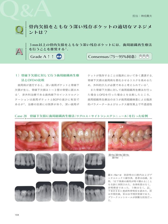 歯周炎ステージⅠ・Ⅱ・Ⅲ診療ガイドライン
