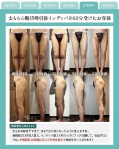 インディバ - 東京・銀座の美容外科クリニック｜WOM CLINIC GINZA