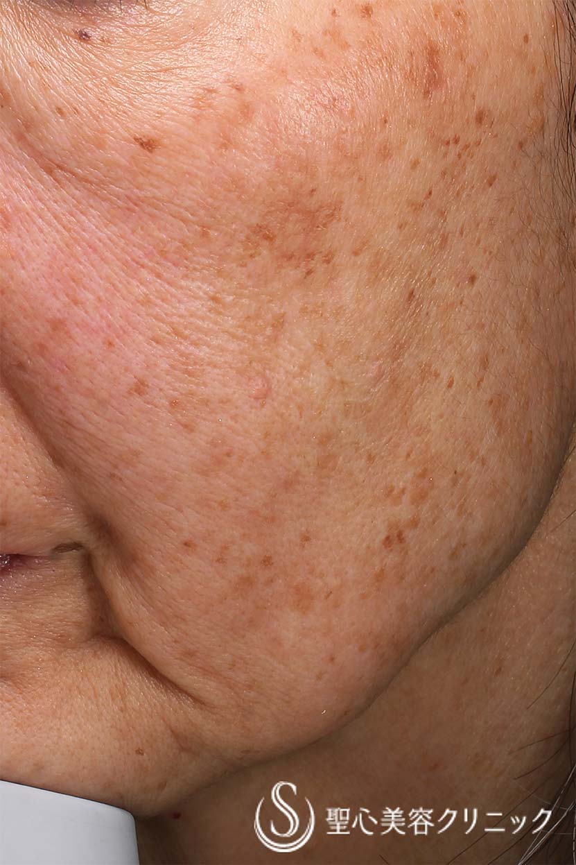 美容皮膚科「シミ・そばかす・肝斑」の症例写真｜聖心美容クリニック熱海院