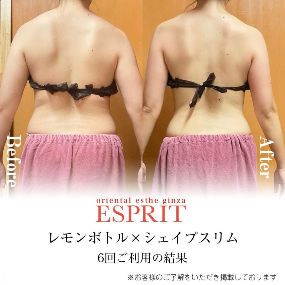 東京で話題！【レモンボトル×人気のラジオ波】2025年7月痩身エステの