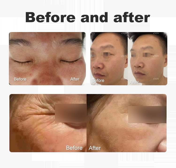 Vmax hifu machine - ODI lazer hair removal machine,slimming machine