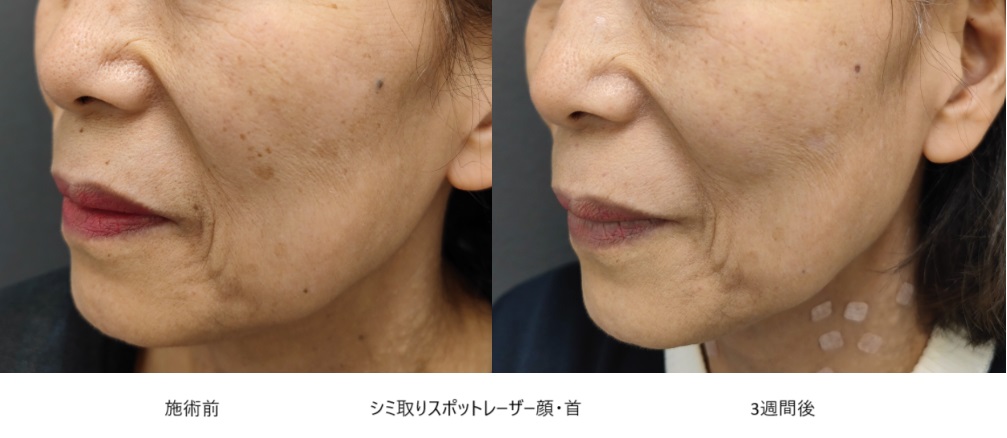 レーザーで全顔のシミ・そばかすを除去した症例②
