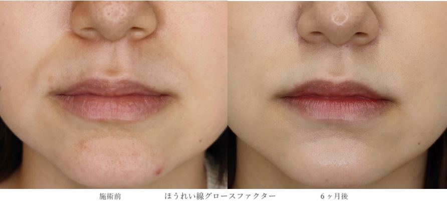 若いのにほうれい線が目立つ人の特徴と対策方法