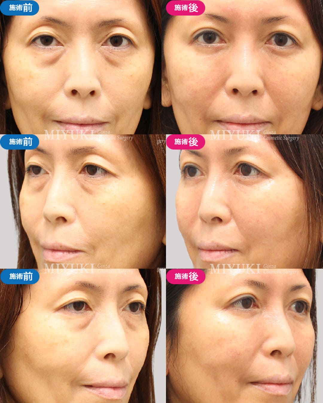 自然で若々しい目元へ～切開を取り入れたエイジングケアで、まぶたの