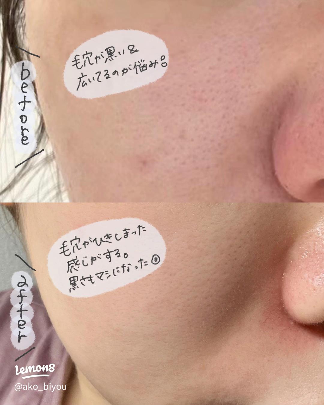 1ヶ月で実感！セロラバイ・ペンタショットで毛穴ケア効果レポート