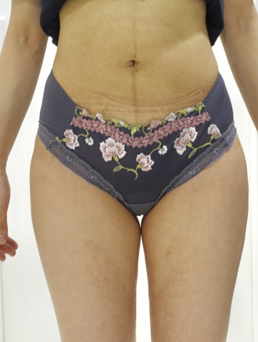 ライポソニックスでお腹とお尻が劇的スッキリ！ - 東京 渋谷 美容皮膚