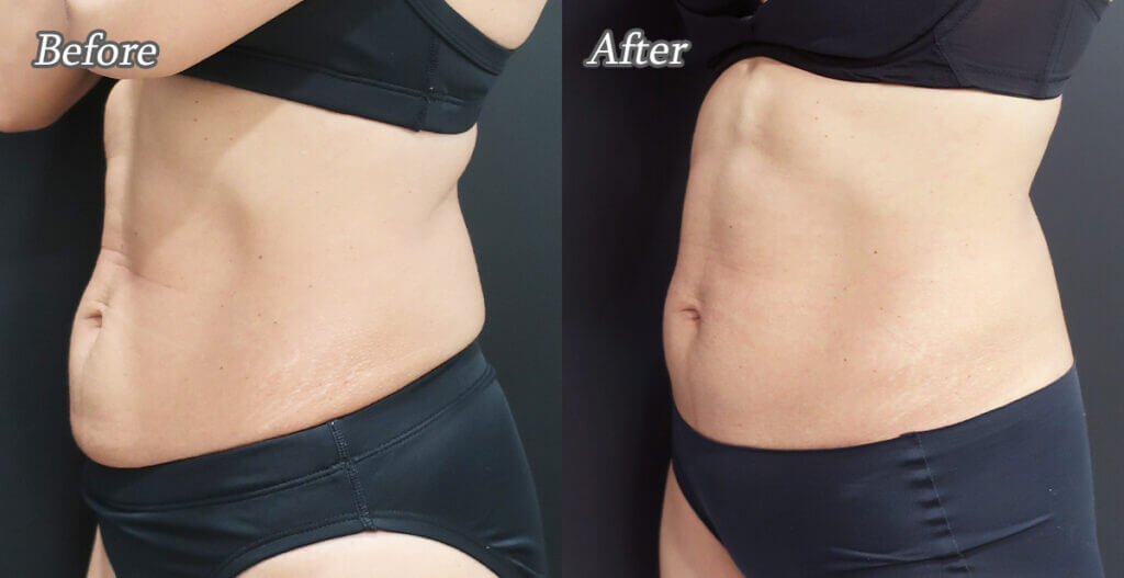 ライポソニックス - 東京 渋谷 美容皮膚科 マグノリア皮膚科クリニック