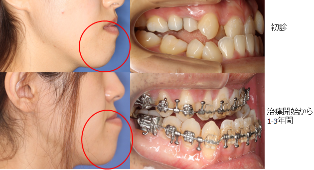 保険診療】顎変形症治療 | 診療科・部門 | 済生会横浜市南部病院