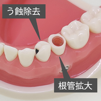 統合型実習用模型 [D16HD-X.1602]｜株式会社ニッシン｜歯科模型・歯科