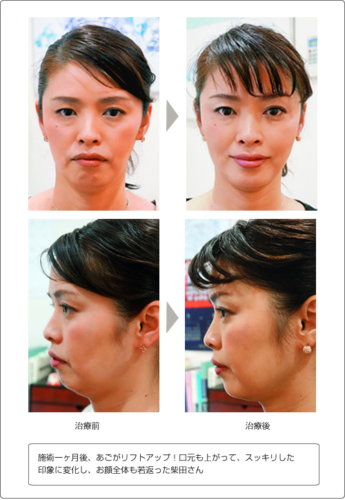 PRPサーマクールNXT | 福岡の美容皮膚科・美容外科 佐野クリニック