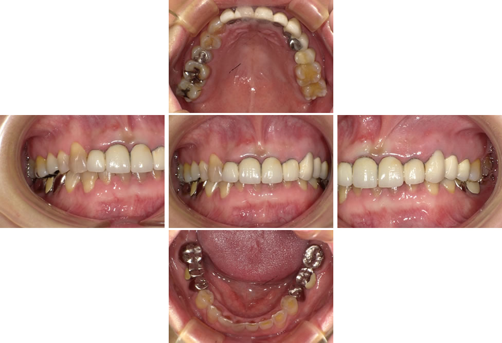 インプラント(抜歯即時埋入)で咬み合わせを回復した症例 | 本厚木の歯医者