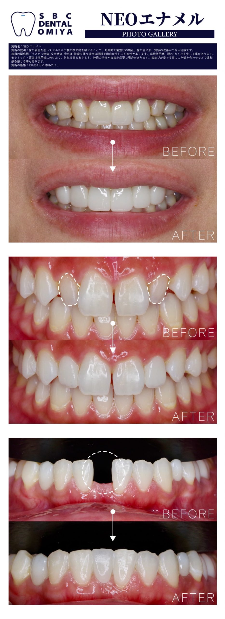 歯を削らない治療？NEOエナメルの効果・値段・デメリットを徹底解説
