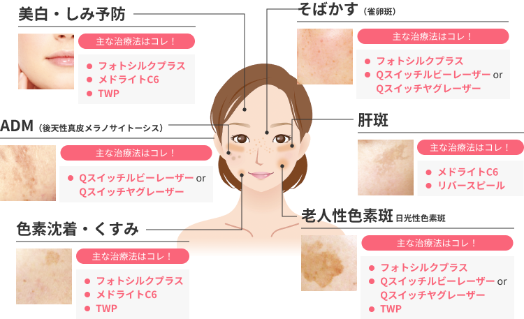 しみ 治療｜美容皮膚科シロノクリニック | 恵比寿院(東京都渋谷区)