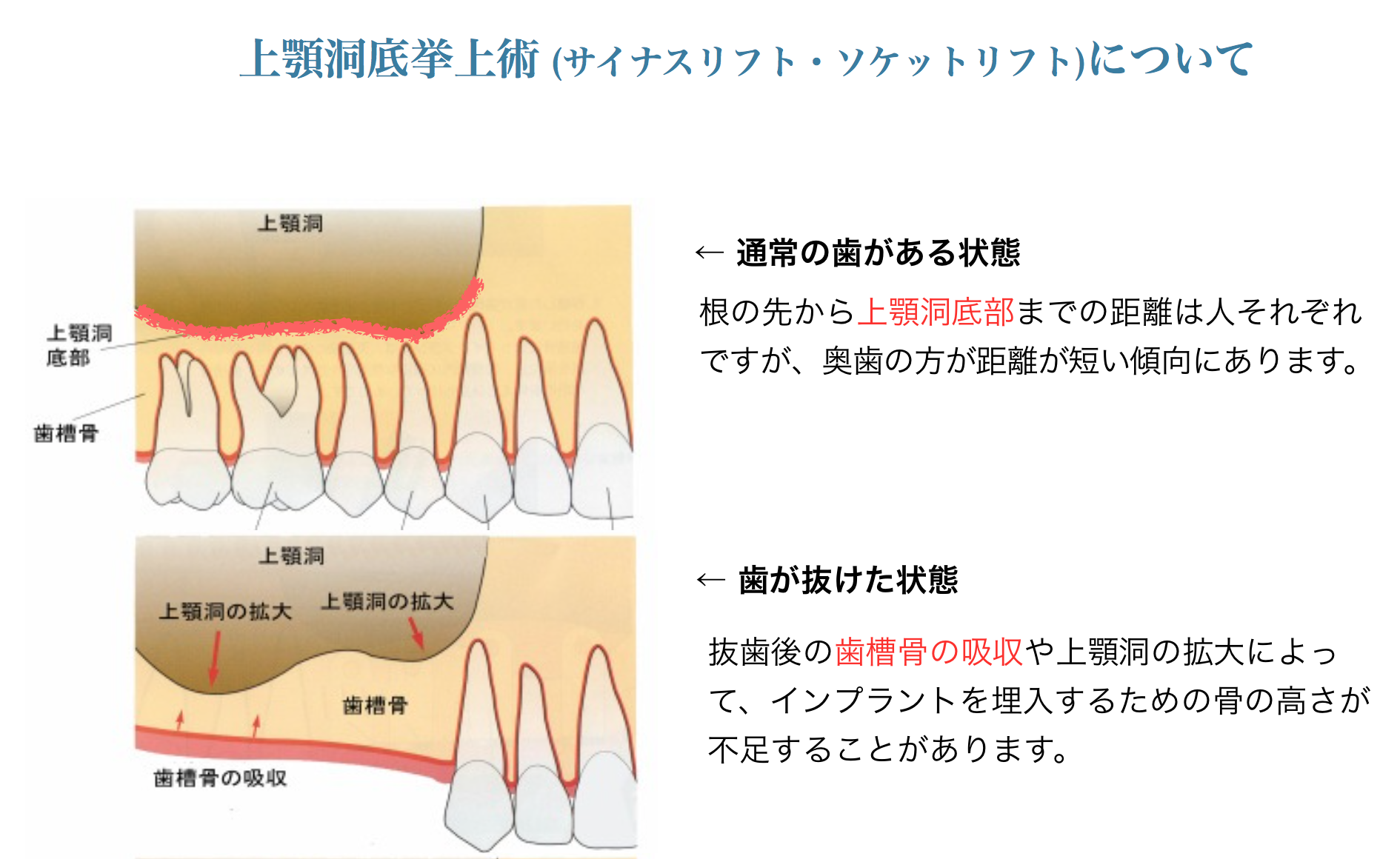 上顎洞底挙上術(サイナスリフト)とは｜京都 歯周病・インプラント