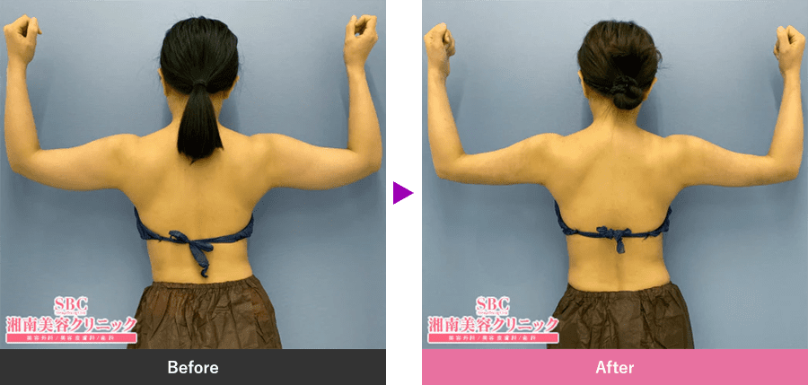 二の腕の脂肪吸引｜脂肪吸引なら湘南美容クリニック【公式】