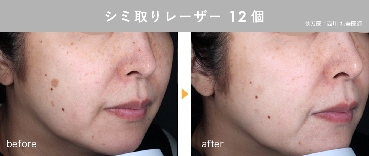 湘南美容クリニック郡山院のシミ治療【シミ取り】【そばかす】【肝斑