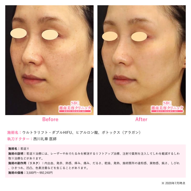 神奈川県で医療ハイフを受けるなら小顔・若返りが得意な武蔵小杉院