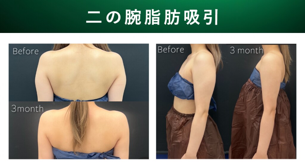 恵比寿】二の腕脂肪吸引するなら「脂肪吸引症例数全国1位」「SNS指名