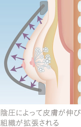 コンデンスビブラ豊胸｜THE CLINIC （ザクリニック）【公式】