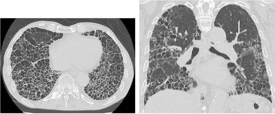 間質性肺炎とは｜間質性肺炎センター｜一般社団法人慈山会医学研究所