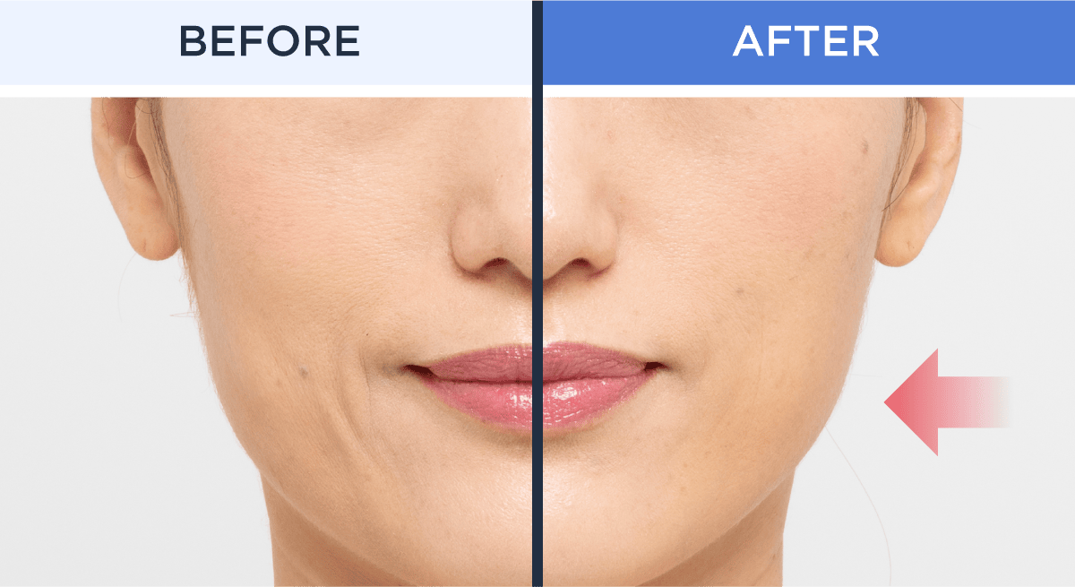 リフトアップ特化型美顔器｜リフトロジー｜ヤーマン公式通販サイト