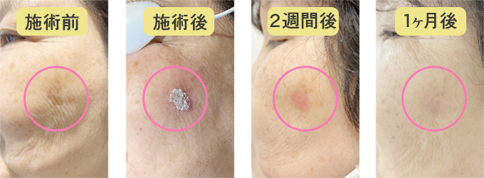 Qスイッチヤグレーザー（トーニング・フラクショナルレーザー・しみ