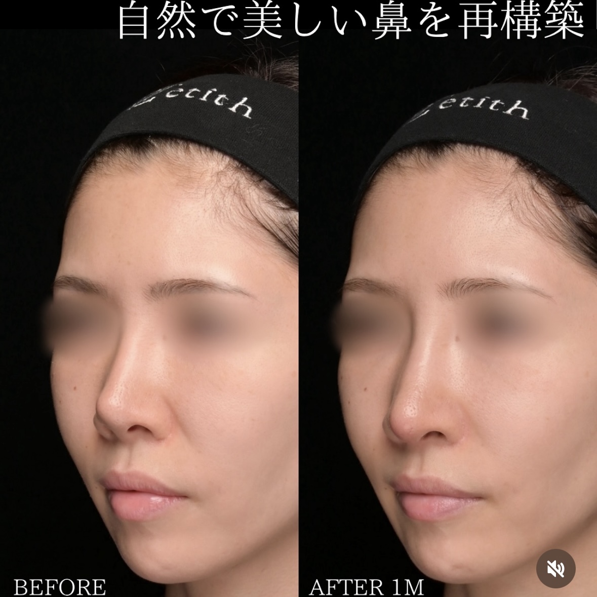鼻整形 - ゼティスビューティークリニック｜鼻整形・鼻形成、美肌専門