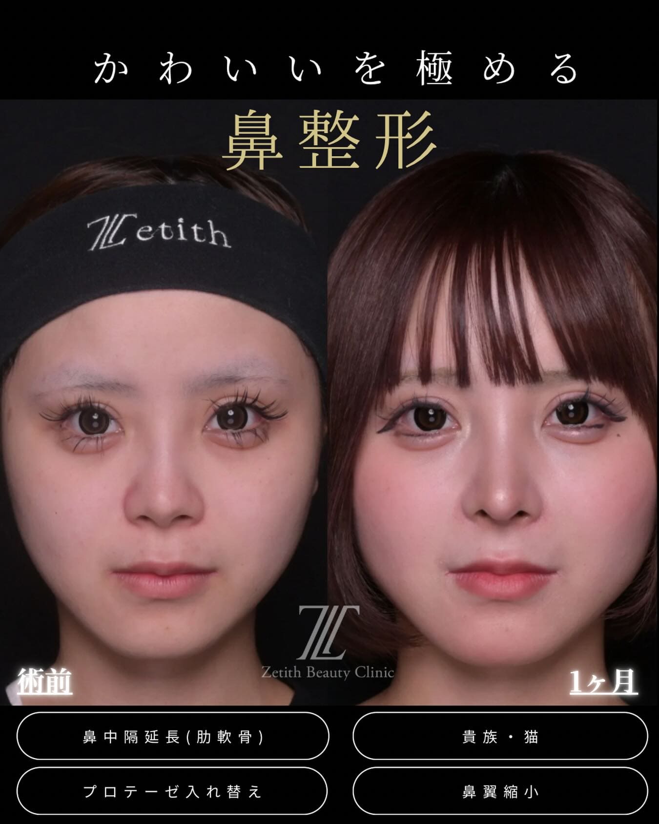 鼻整形 - ゼティスビューティークリニック｜鼻整形・鼻形成、美肌専門