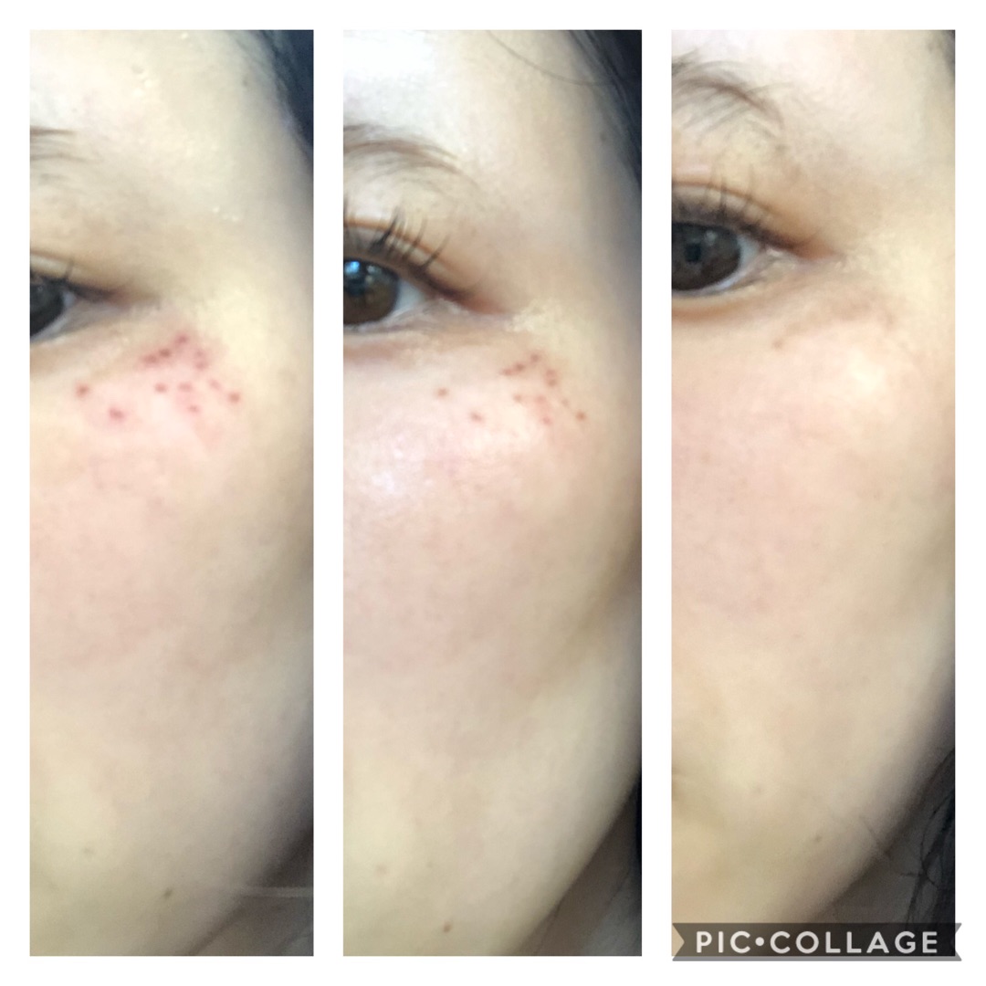 低周波ペンシルのシミケア効果を解説｜従来のシミケア法と比較 – 美容