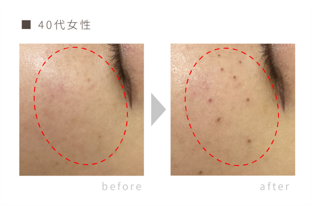 シミケア専用機器 ピンポイントケア | 春日井市【本気の肌改善】シミ