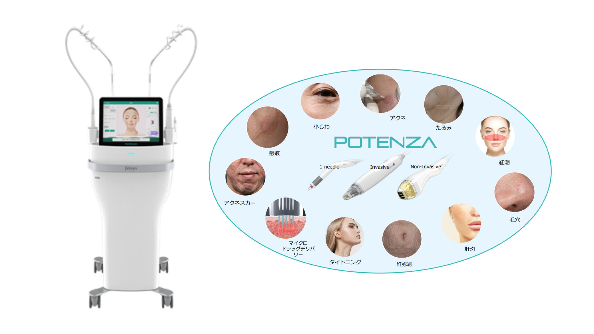 マイクロニードルRF（ポテンツァ®） | 美容皮膚科 | あまの皮ふ科