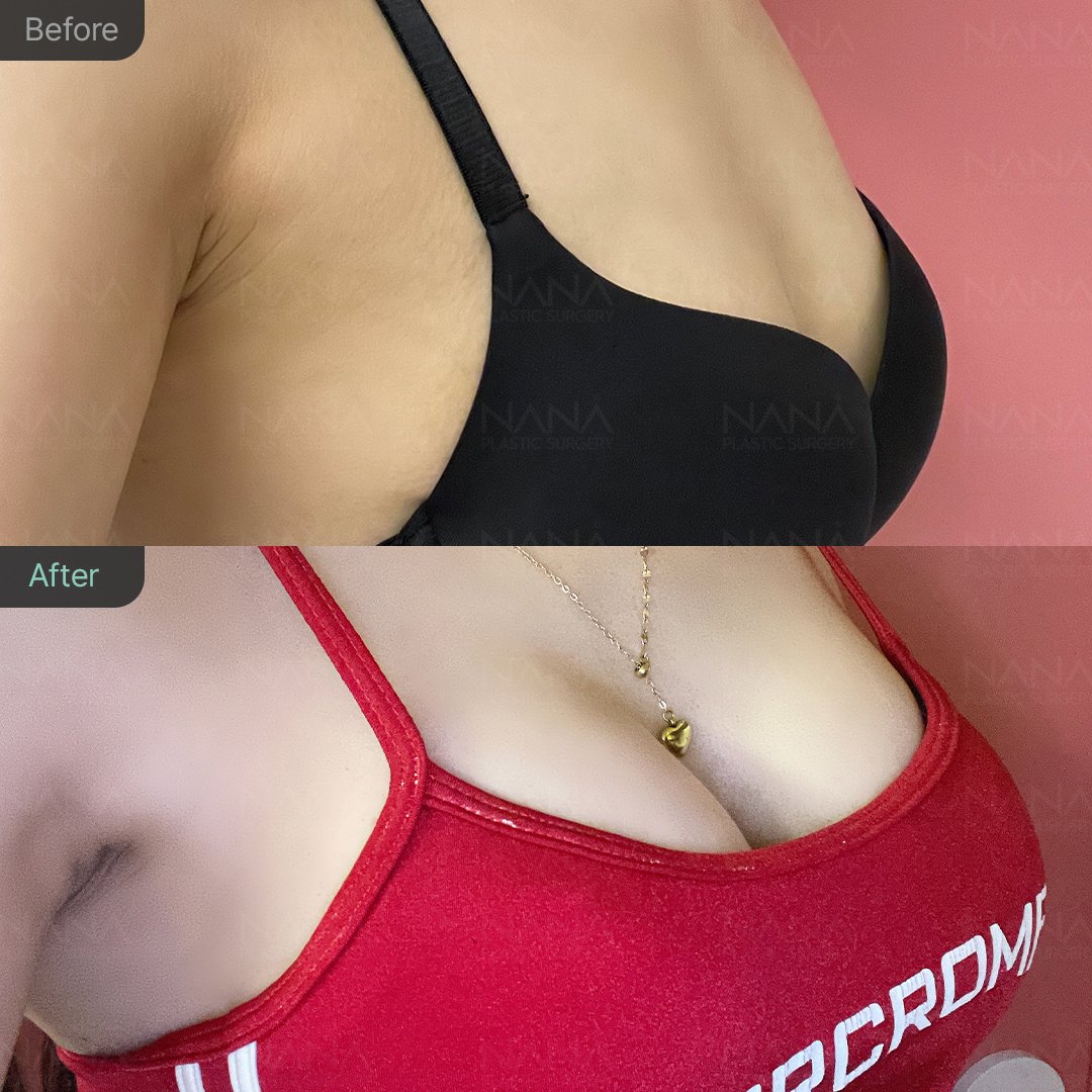 NANA豊胸手術⭐Before&After⭐症例写真｜韓国整形NANA美容外科