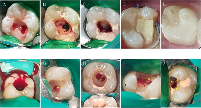 Preserving pulp vitality for teeth with post-vital pulp therapy