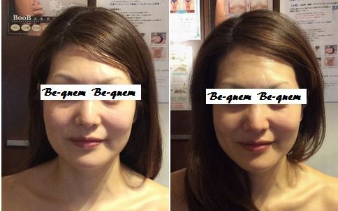 フェイシャルコース｜筋膜リリース、ハイパーナイフは、大阪・鶴見