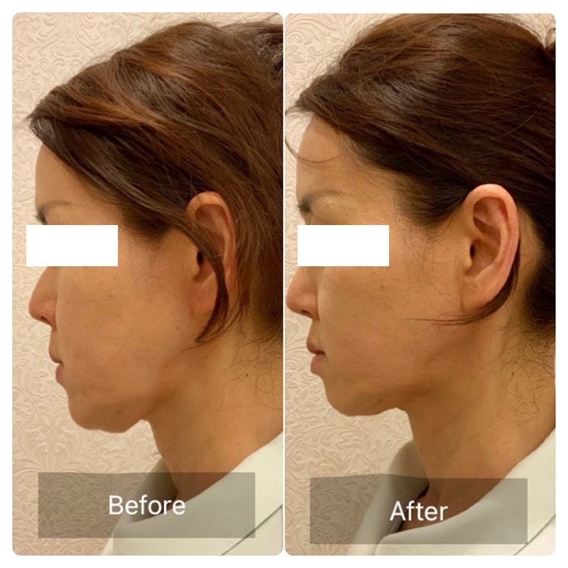 HIFU（リフトアップ・小顔）｜木本アンチエイジング美容皮膚科 兵庫県