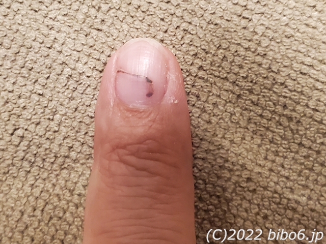 割れた爪の補修 - 備忘6.jp