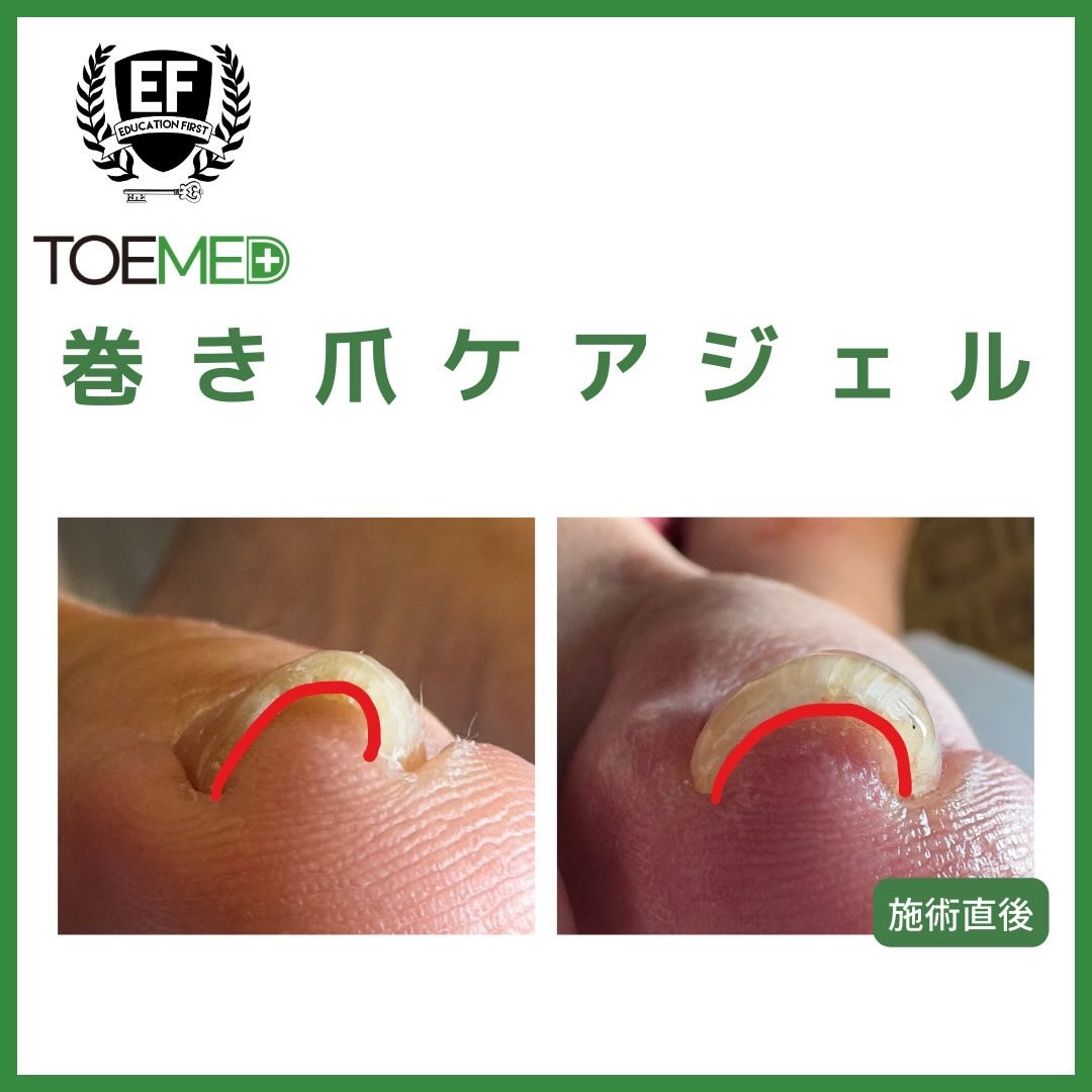 TOEMED 巻き爪ケア 3点セット 楽天市場】TOEMED 3本セット 巻き爪アップジェル 韓国流行中 KOREA