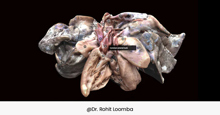 小児心臓病学における研究と学習の変革：3Dスキャン技術の活用