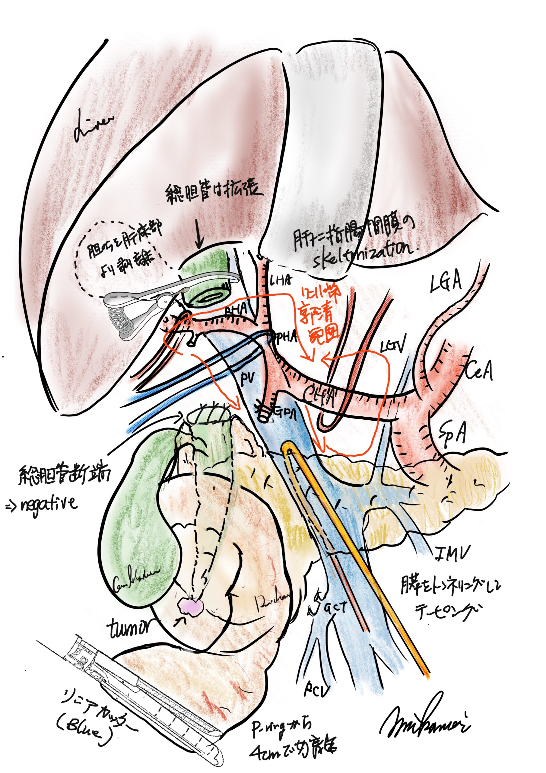 外科医の手術記録（オペレコ）とは？ - 西宮敬愛会病院 COKU 鼠径