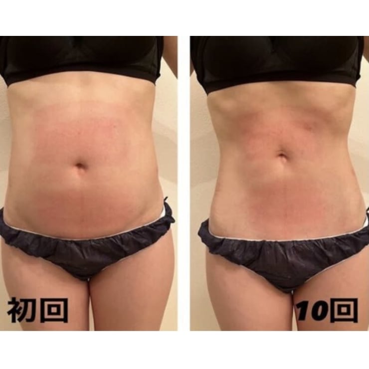 12℃脂肪冷却×世界初！次世代EMS寝てるだけで約2万回の腹筋効果