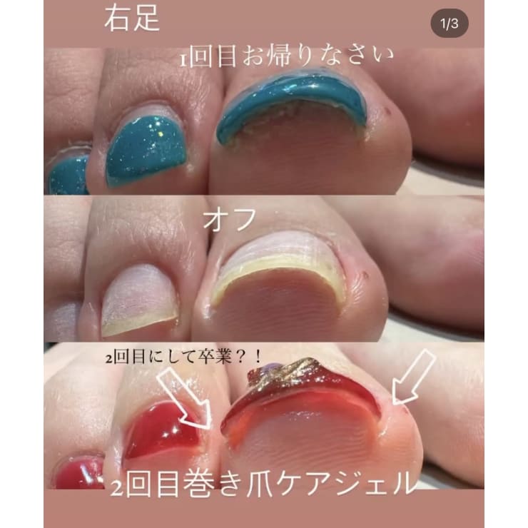 巻き爪で痛みを感じてる方、巻き爪予備軍の方必見！！巻き爪ケアジェル