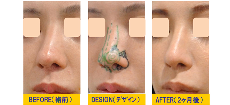 鼻整形の修正「OPEN法の瘢痕と鼻中隔を完全CLOSE法で修正（鼻中隔延長
