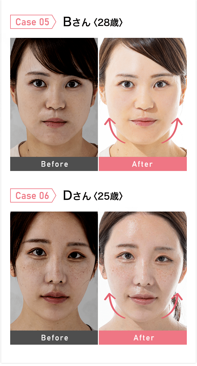 スキンケア革命】スキンアイロン - 韓国発！20万台完売の1台6役の