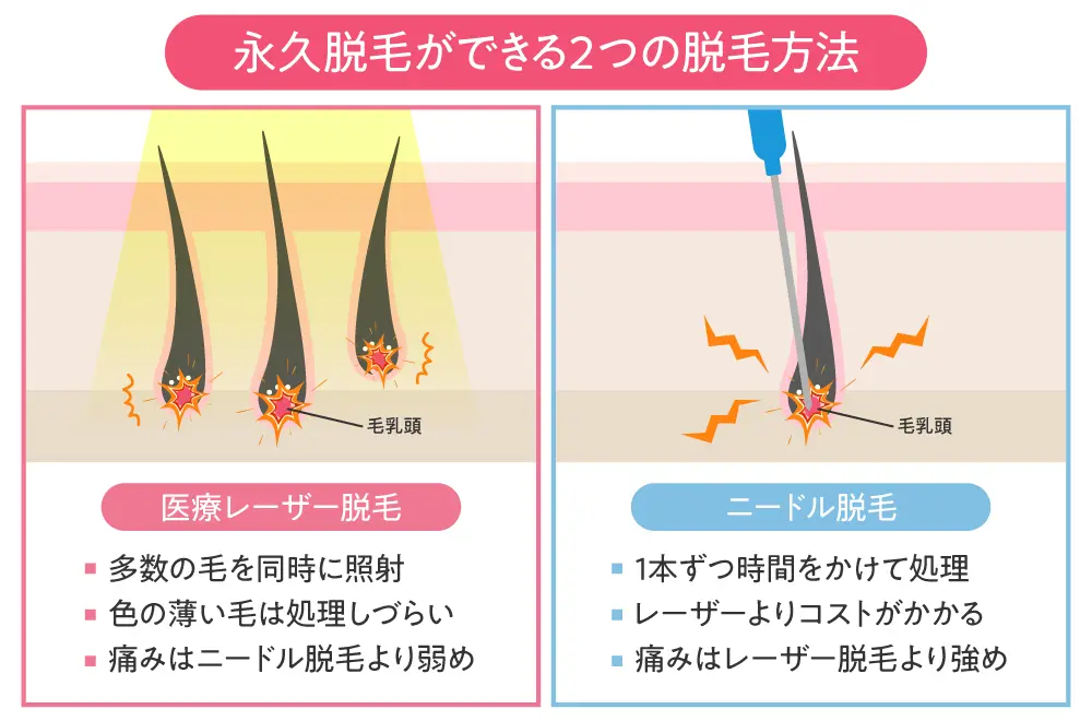 医療脱毛は永久に毛が生えない？永久脱毛の効果、値段を徹底解説｜エミ